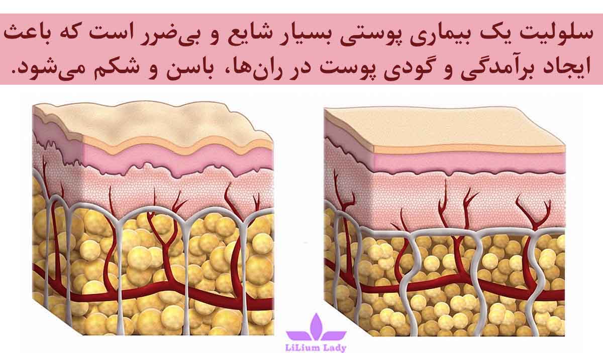 سلول های چربی زیر سلولیت